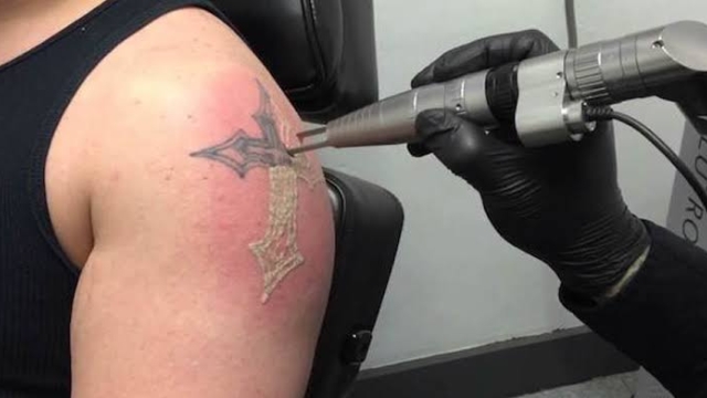 Tattoo Laser Removal –  Great Why Your Tattoo May Be Required To Go!