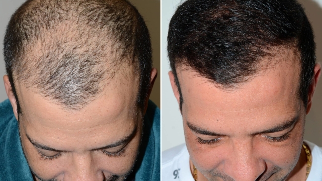 Hair Transplants: Unlocking the Secret to a Fuller Mane