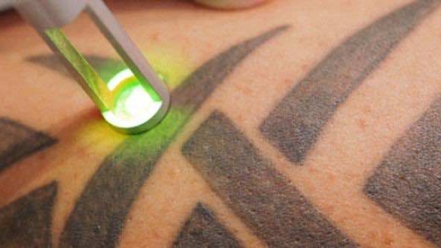 Run From Your Skin? Make Room For First Tattoos With Laser Removal