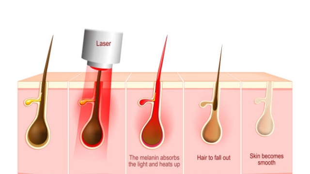 Laser Hair Removal: A Smooth Solution